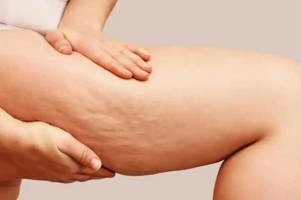Image of woman showing leg with cellulite Bridgnorth