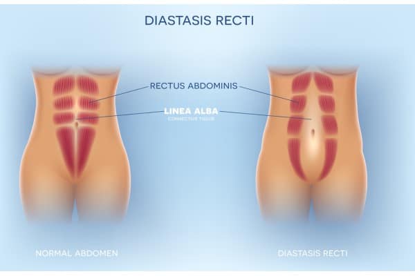 How Does Non-Surgical Treatment Help With Loose Skin, Weak Abdominal Muscles and Post-Pregnancy Changes Bridgnorth?