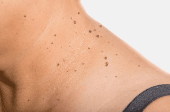 Are you looking for easy skin tag removal Bridgnorth - then contact Spire today!