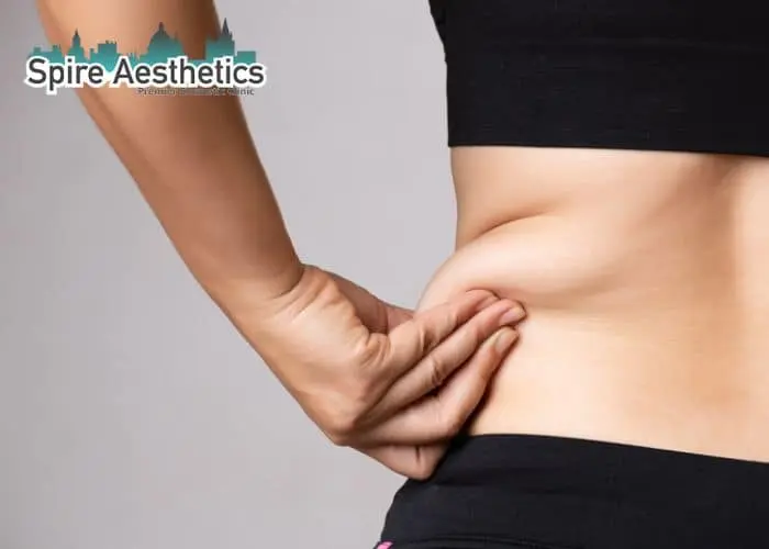 Image of woman pinching fat on their hips Bridgnorth. Fat Freezing treatment