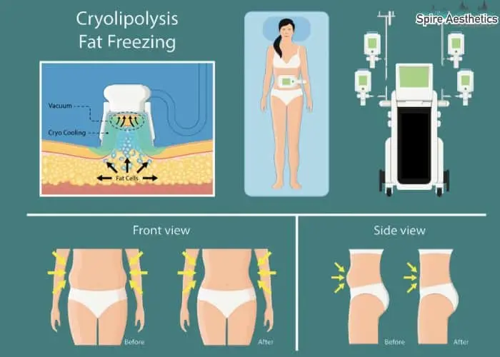 Fat freezing treatment Bridgnorth benefits for competitions to remove stubborn fat deposits.