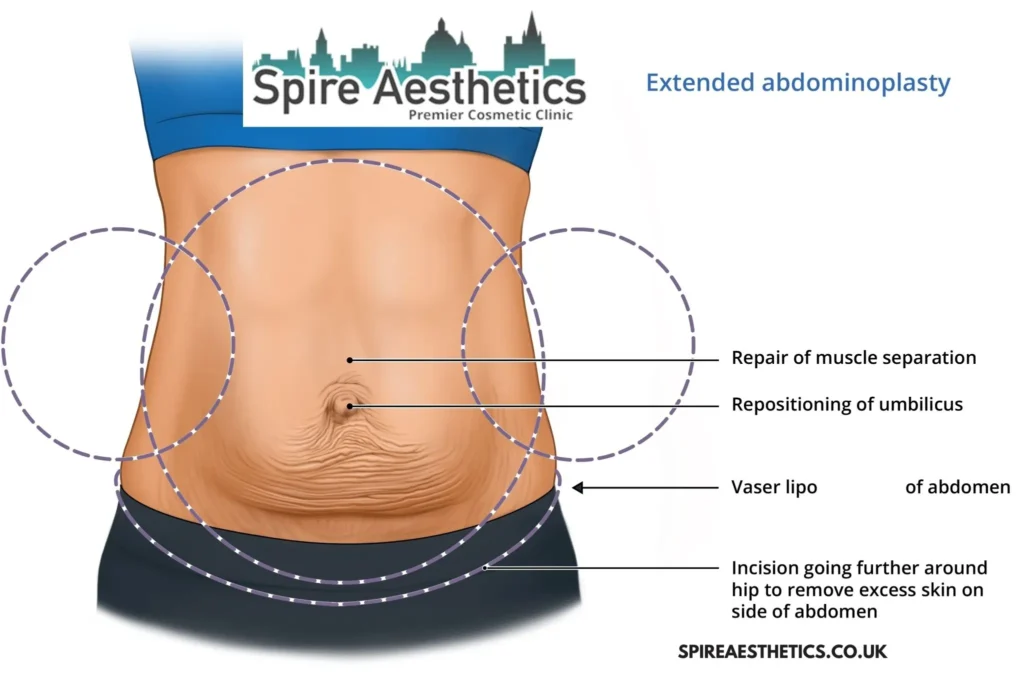 Understanding Loose Skin After Gastric Band Bridgnorth Surgery and HIFU Treatment 