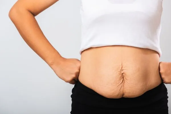 Image of a woman's stomach after weight loss with sagging skin following a gastric band Bridgnorth