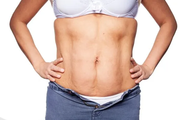 sagging skin on woman's stomach after weight loss injections Bridgnorth