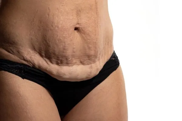 Image of womans stomach after weight loss injections Bridgnorth showing saggy skin