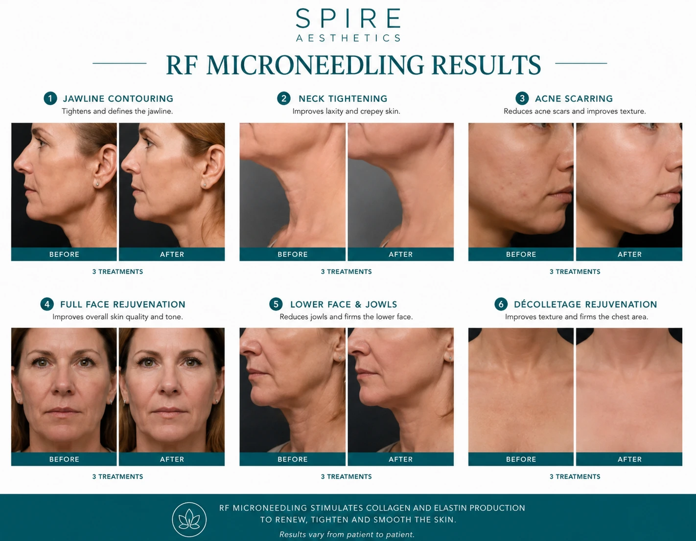 RF Microneedling Skin tightening Bridgnorth results