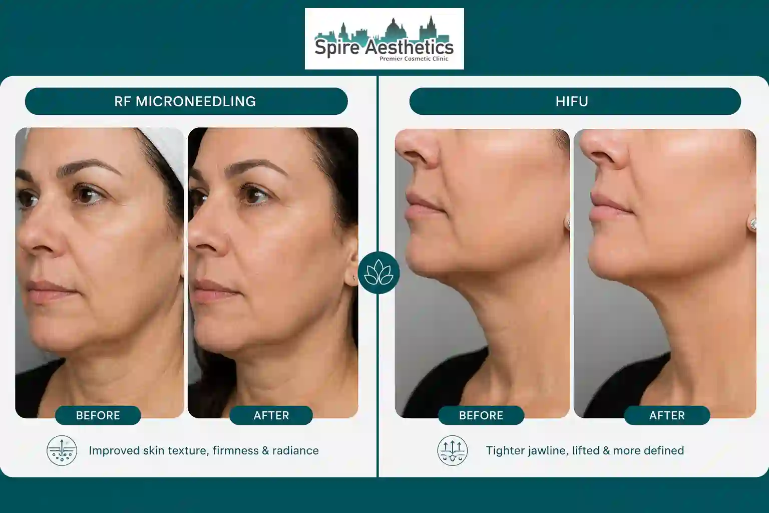 Can RF Microneedling and HIFU Be Combined Bridgnorth?