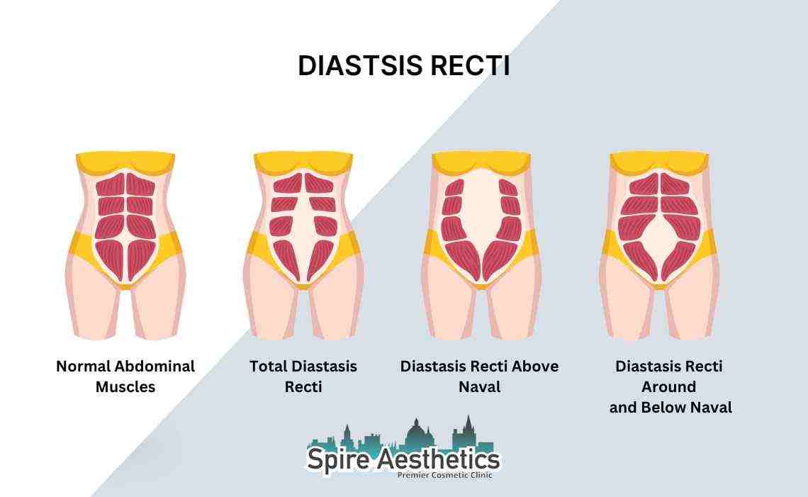 Is Non-Surgical Diastasis Recti Treatment Right for You? Common Concerns Answered Bridgnorth